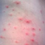 Hot Tub Folliculitis pictures