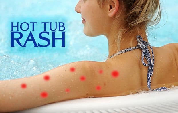 Hot Tub Rash Cure & Pictures